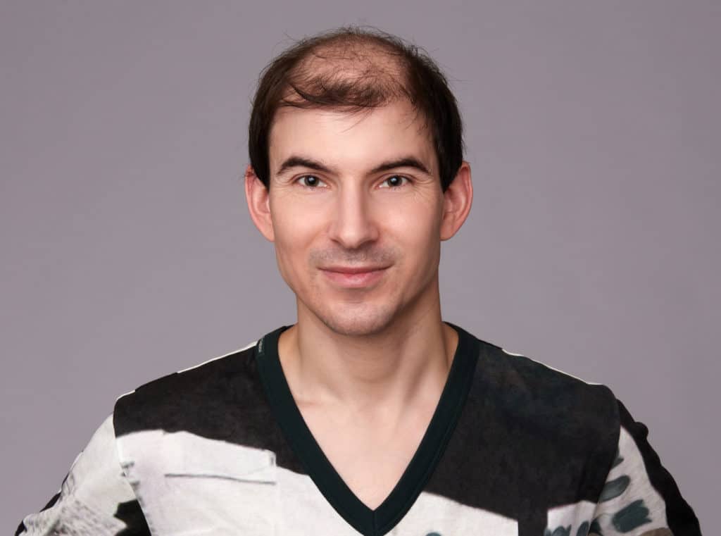 Cheap Hair Transplant