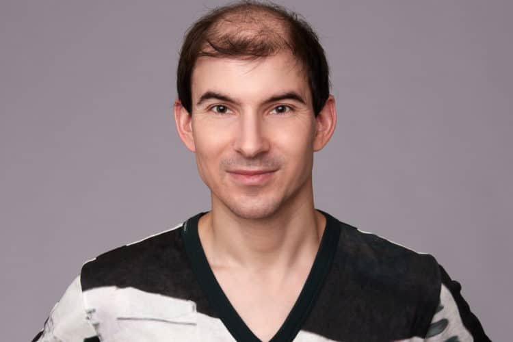 Cheap Hair Transplant