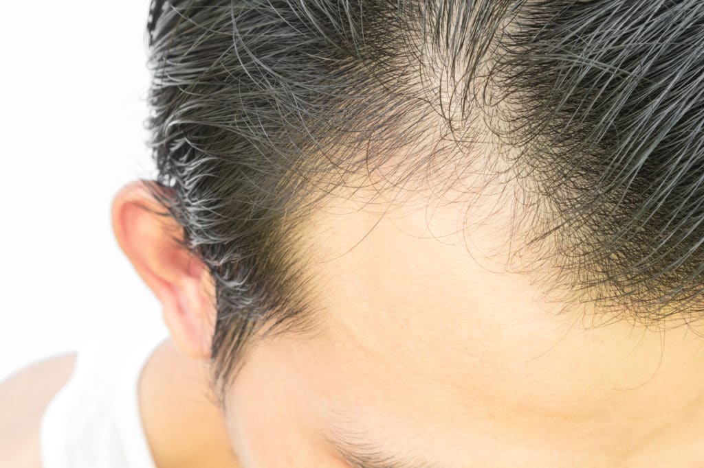 hair transplant