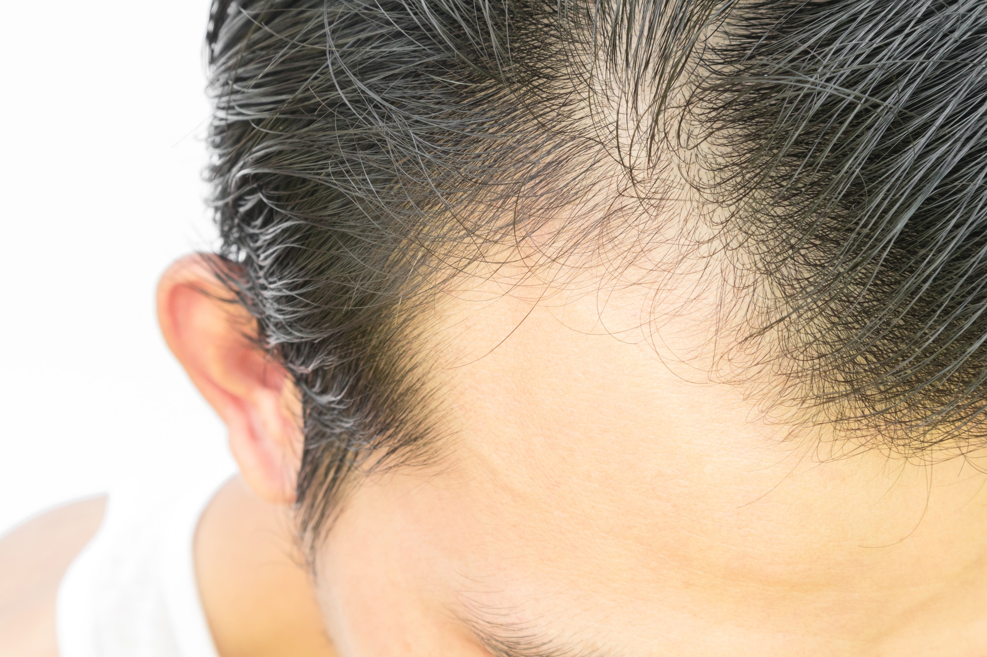 hair transplant